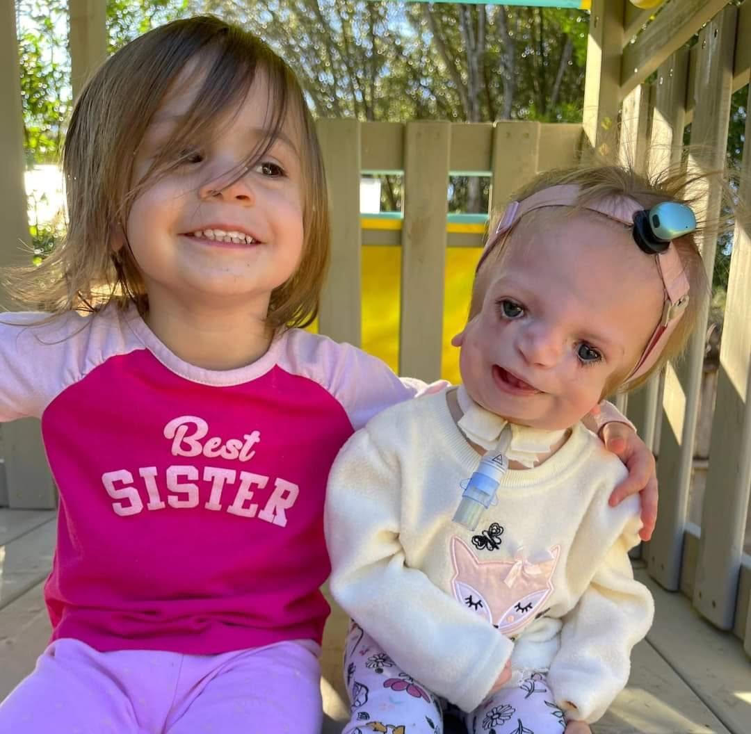 Finlee, a child with Treacher Collins Syndrome, and her sister